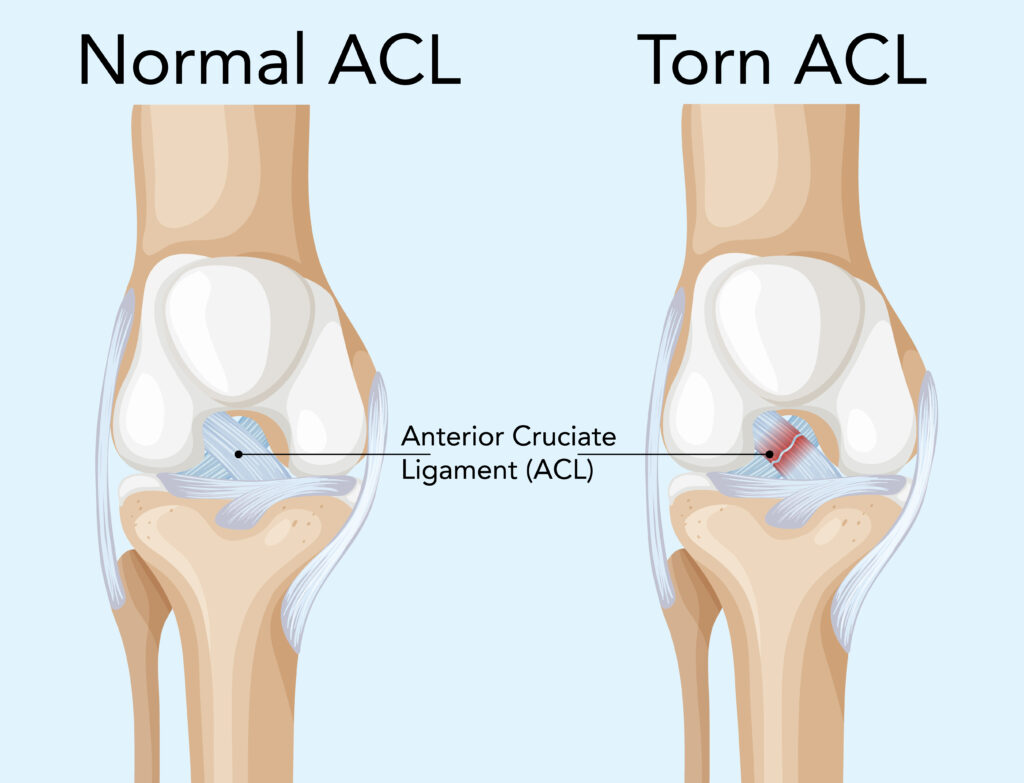 Comparing ACL